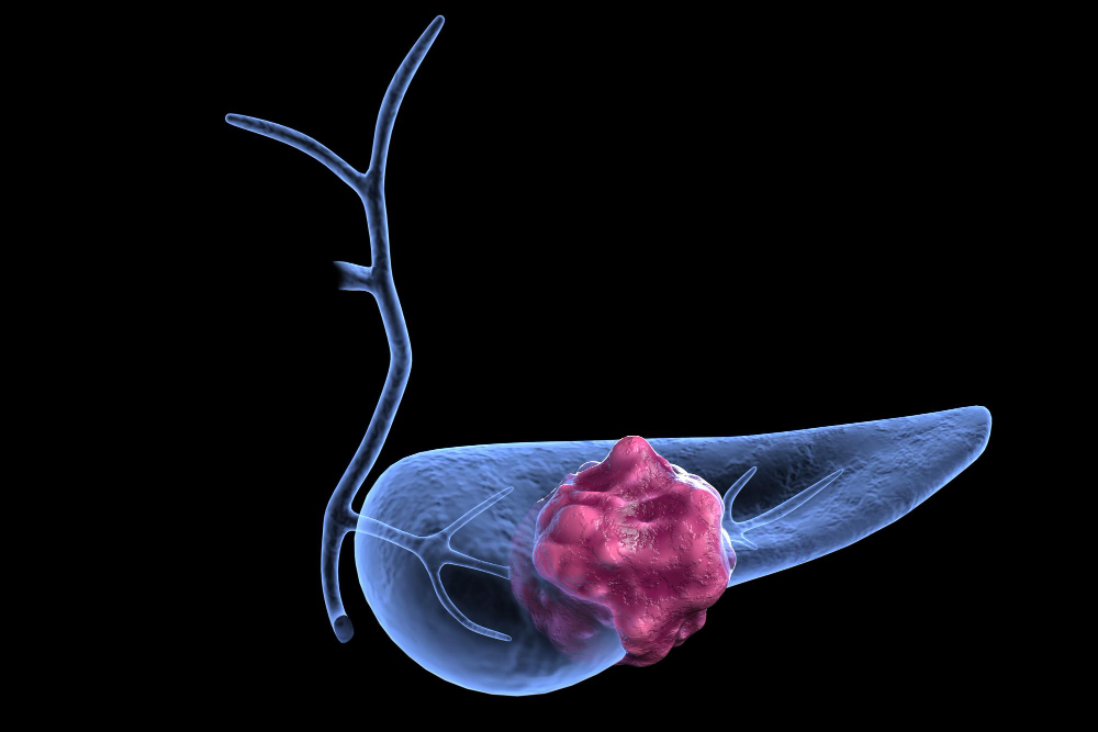 Diagnosi precoce cancro al pancreas: PAC-MANN-1